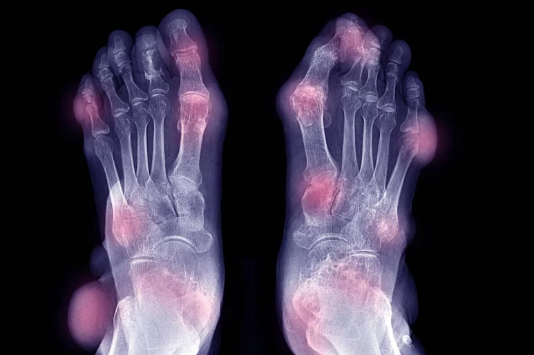 Según la Sociedad Española de Reumatología, las radiografías son normales al inicio de la enfermedad, pero posteriormente pueden mostrar algunas alteraciones que hacen pensar que el paciente presenta gota. Foto: SHUTTERSTOCK.