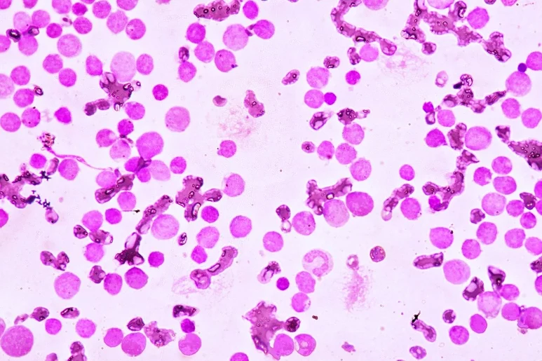 Examen de la sangre en microscopía que muestra leucemia mieloide aguda. Foto: SHUTTERSTOCK.