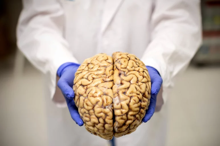 Banco de Cerebros de la fundación CIEN, donde llevan a cabo estudios sobre el Alzheimer. En la imagen, uno de los cerebros humanos que se conserva en el banco. Foto: ALBERTO DI LOLLI.