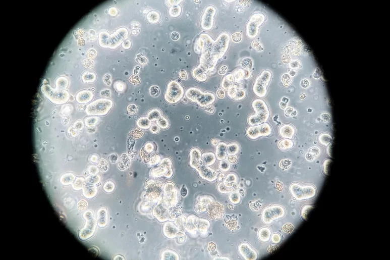 Imagen microscópica de células cancerígenas de mama. Foto: SHUTTERSTOCK