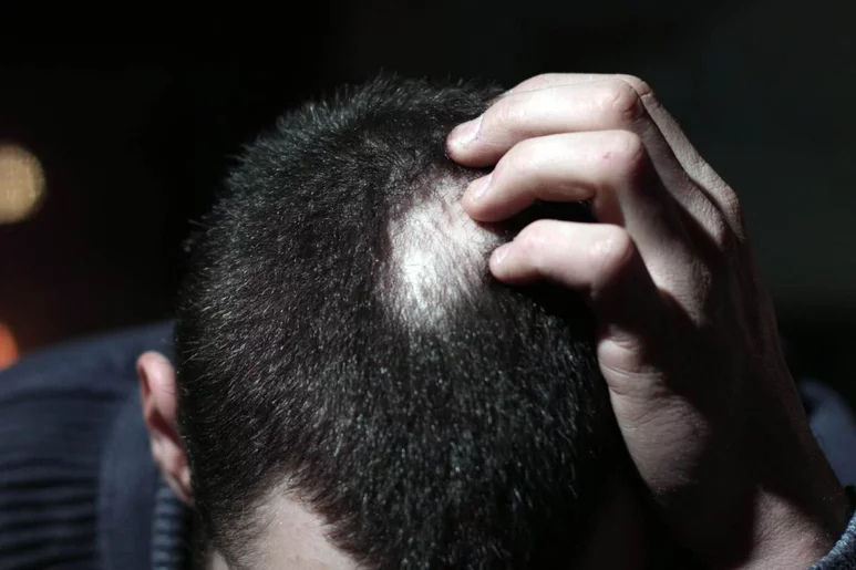 La alopecia areata tiene un alto impacto psicológico y se asocia a estrés, ansiedad y depresión. Foto: SHUTTERSTOCK