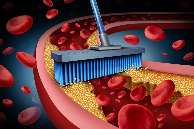 La arteriosclerosis surge por el depósito de grasa procedente de la circulación sanguínea en la pared de las arterias. Foto: SHUTTERSTOCK