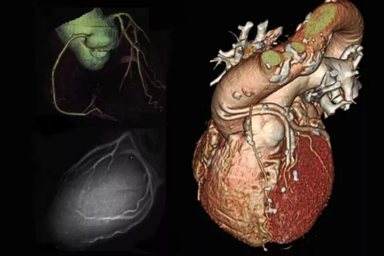 La tomografía muestra arterias coronarias con calcio. Foto: DM. 