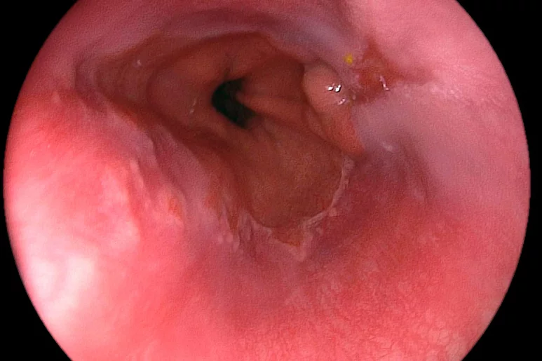 La endoscopia es actualmente el método para detectar esofagitis. Foto: AGEFOTOSTOCK. 