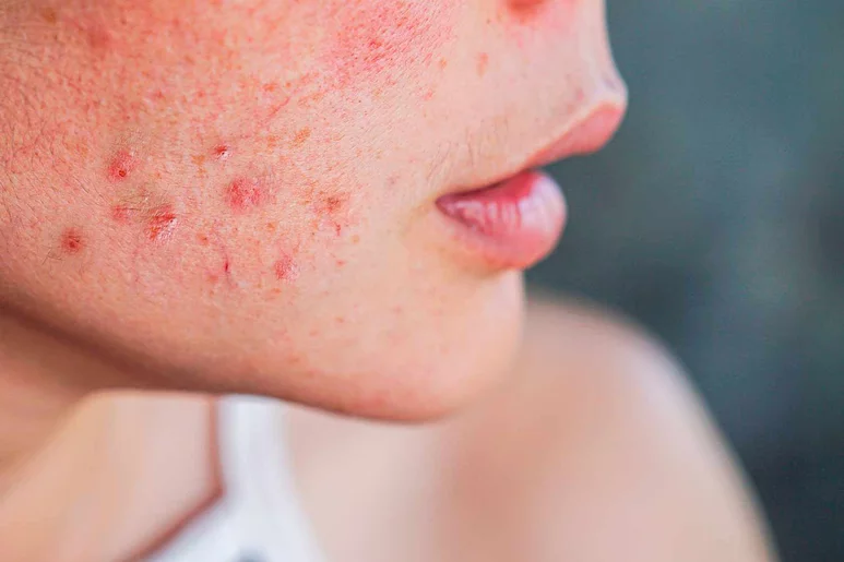 Las terapias contra el acné presentan riesgos de efectos secundarios. Foto: DIARIO MÉDICO. 