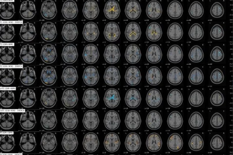 Resonancias magnéticas (RM) cerebrales. Foto: DM