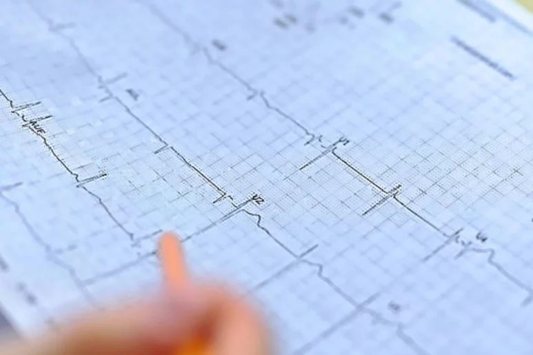 El perito judicial considera que hubo mala praxis al no hacer a la paciente un electrocardiograma en Urgencias.
