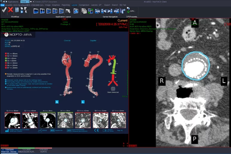 Arva permite la reconstrucción de una aorta en 3D a partir de TC. Foto: INCEPTO