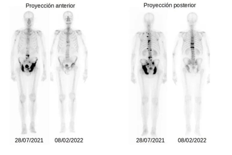 Resultados del tratamiento usando radioligado de lutecio en un paciente con cáncer de próstata avanzado. Imagen: J. L. CARRERAS.